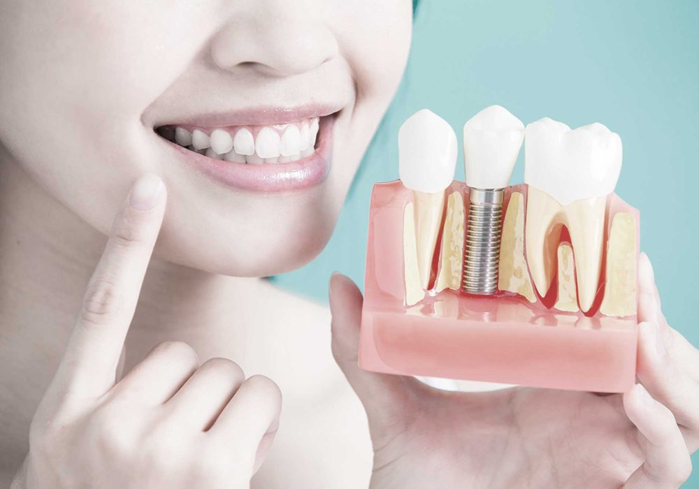 implantes_dentarios